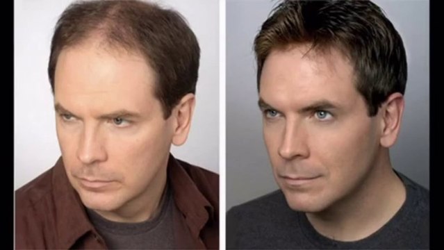 Total hair regrowth | How to Regrow Your Hair | Stop Hair Loss And Regrow It The Natural Way