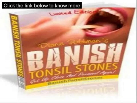 Banish Tonsil Stones Book Review - Banish Tonsil Stones Review