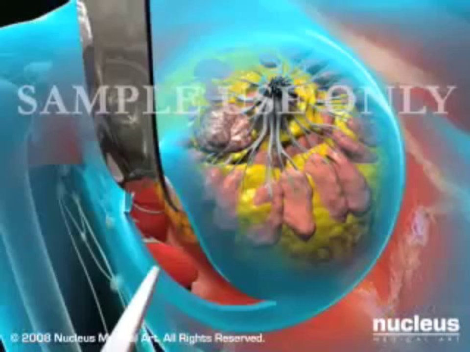 Breast Cancer Surgery  Lumpectomy  Mastectomy [human anatomy]