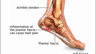 Pain in Heel of Foot | How to Get Rid of Plantar Fasciitis, Achilles Tendonitis Pain in Heel of Foot