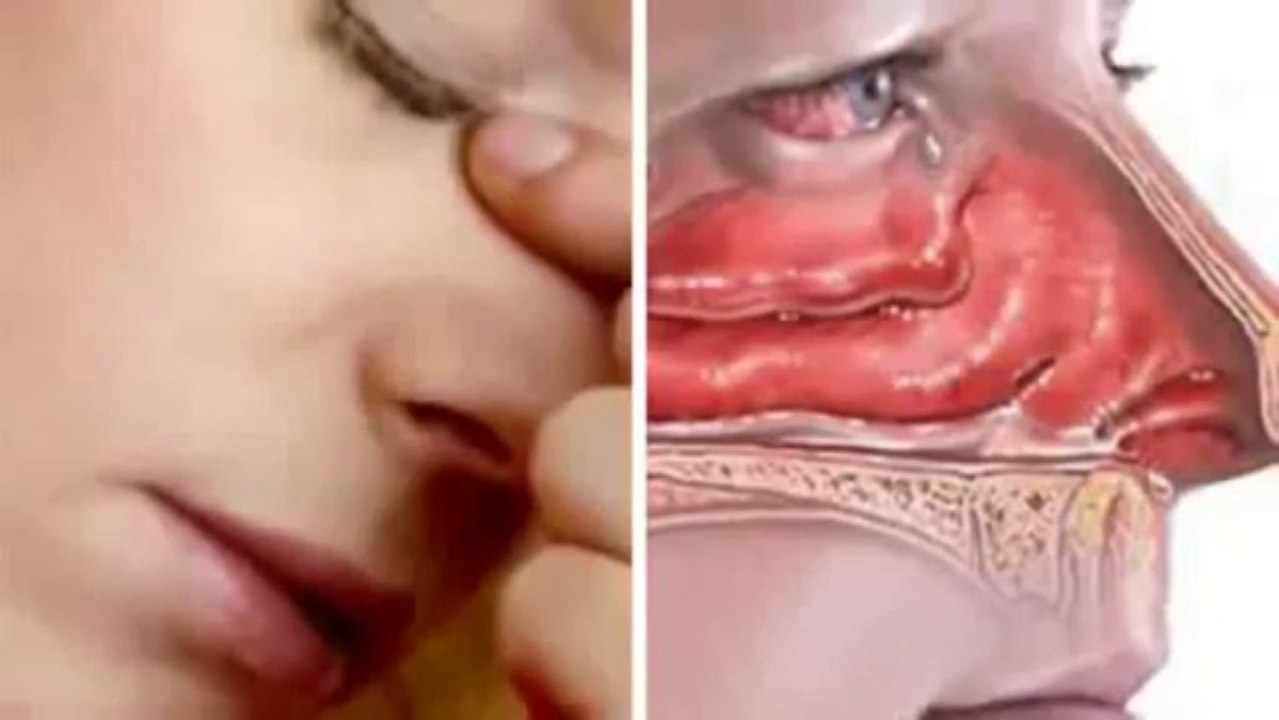 Nasal Polyps Treatment Miracle Review - Watch I Cured My Nasal Polyps!