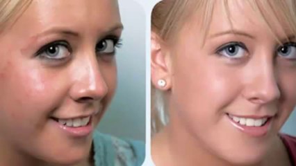 Milagro Para El Acne Cura Natural