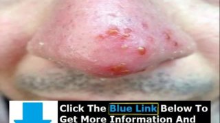 Can You Get Rid Of Herpes Simplex + Can U Get Rid Of Herpes