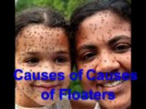 Causes of Causes of Floaters - Eye Floaters no More Review