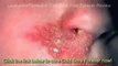 Watch Cold Sore Free Forever Free, Do You Really Want To Get Rid Of Your Cold Sores