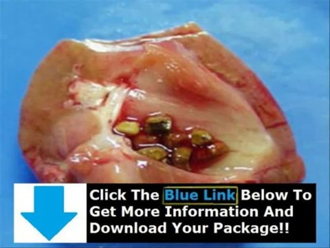 Kidney Stone Medicine Over The Counter + Joe Barton Kidney Stone Remedy Review