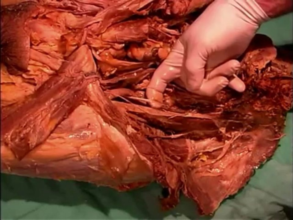 Human Anatomy Dissection 25 Hip and Thigh