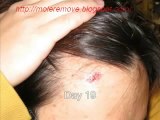Moles Warts and Skin Tags Removal Review - Live Free of Skin Tags