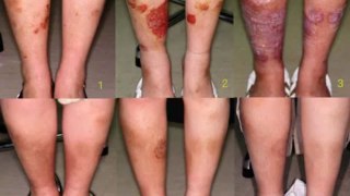 psoriasis free for life review katy wilson