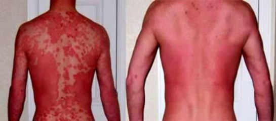 Psoriasis Free For Life Review +Bonus Only for Today