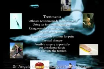 Plantar Fasciitis | Dr. Angela Drury | Albuquerque, NM
