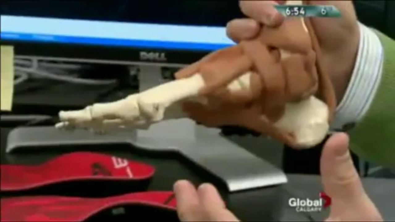 Plantar Fasciitis