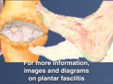 Heel Pain - Plantar Fasciitis - Treatments