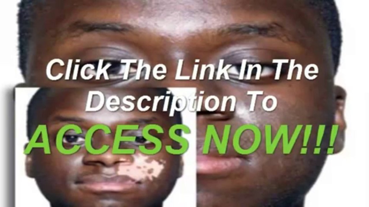 Natural Vitiligo Treatment System Review-Natural Vitiligo Treatment