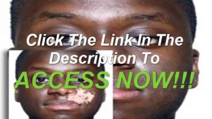 Natural Vitiligo Treatment System Review-Natural Vitiligo Treatment