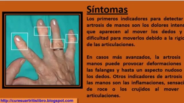 Cure su Artritis: Artritis en las Manos Tratamiento Natural