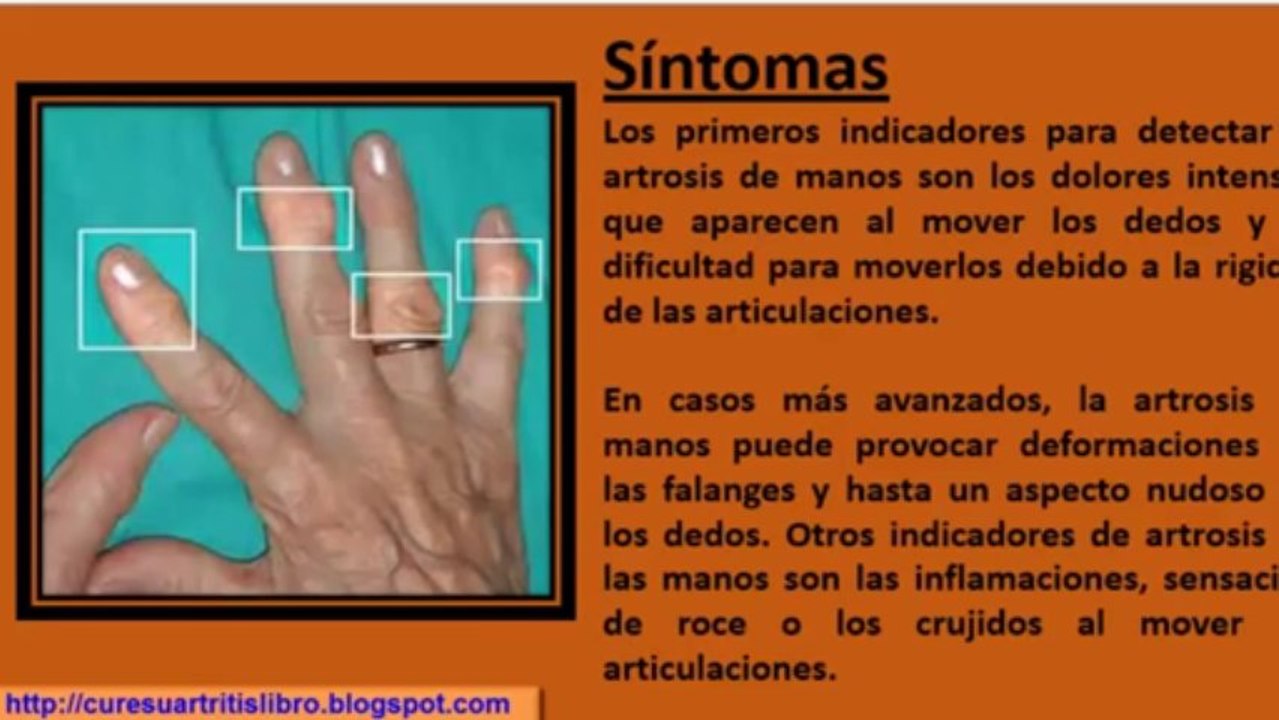 Cure su Artritis:  Artritis en las Manos Tratamiento Natural