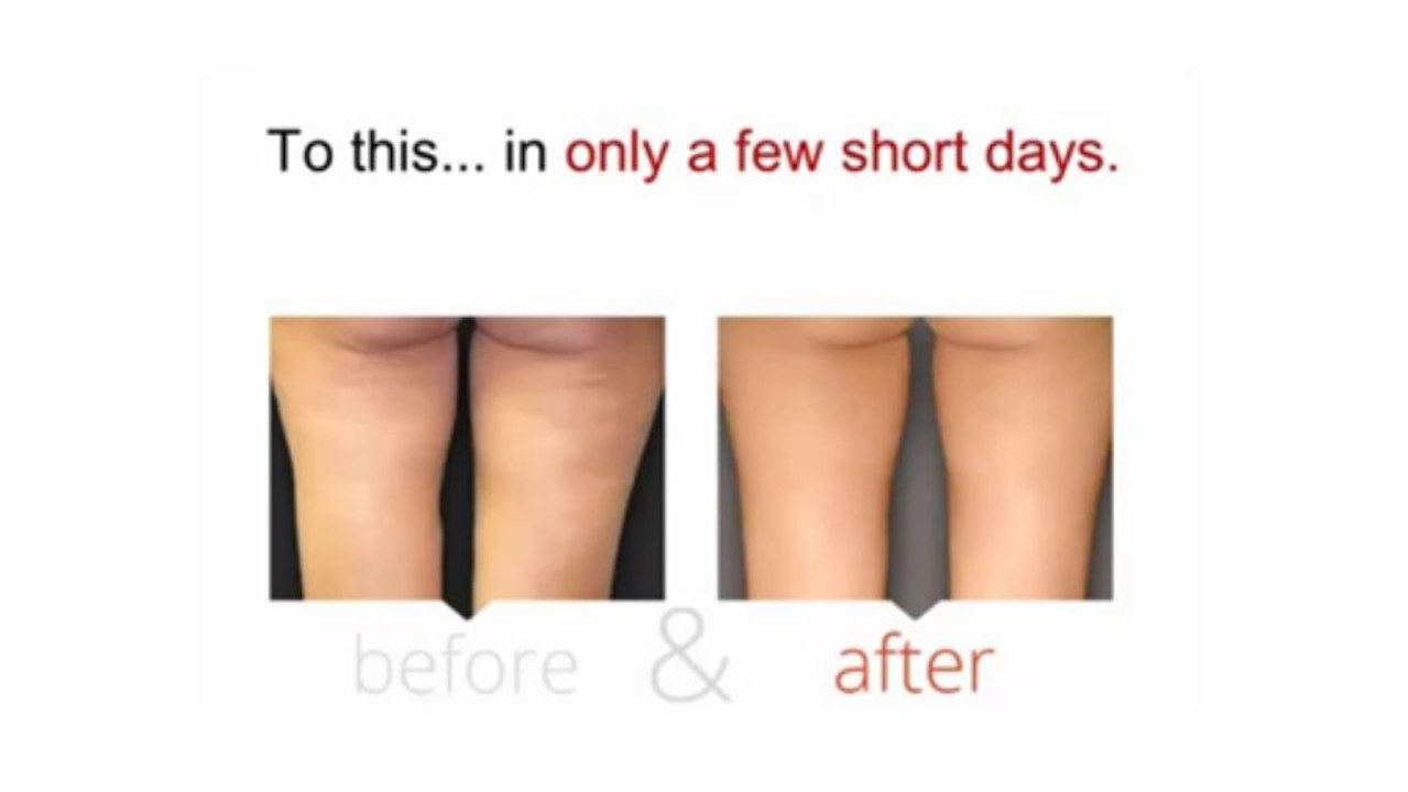 Cellulite Factor Review   What To Expect
