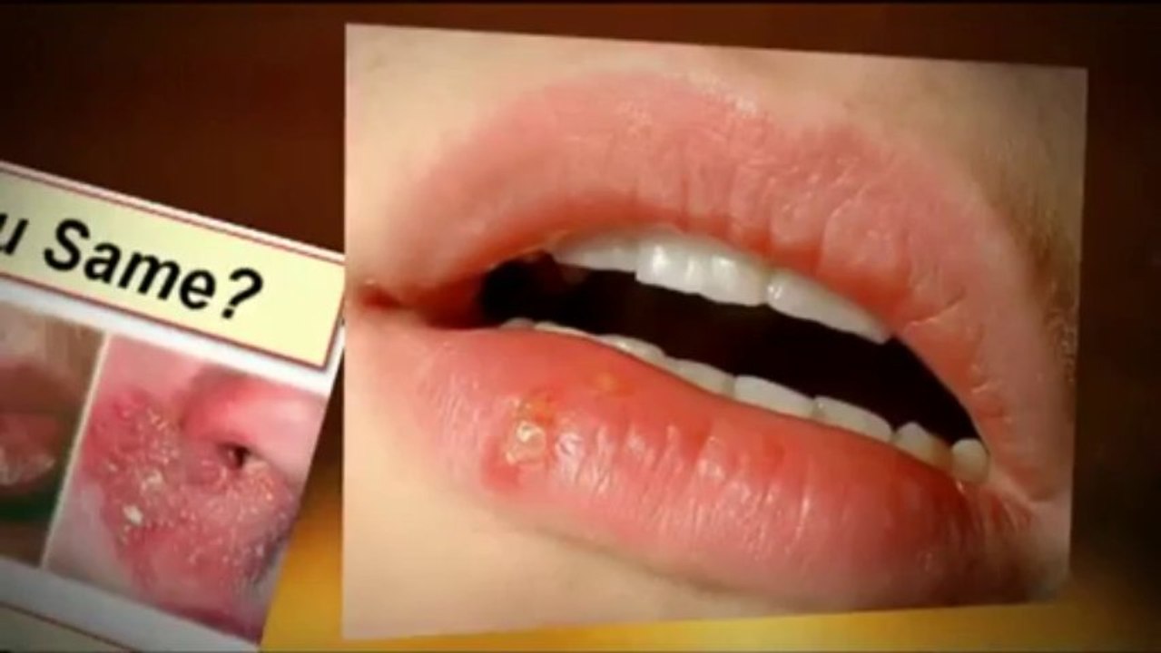 Cold Sore Free Forever Reviews | Cold Sore Free Forever Scam