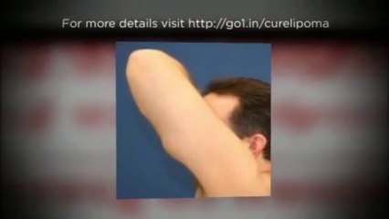 Cure Lipoma Naturally