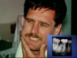 Root Canal Treatment