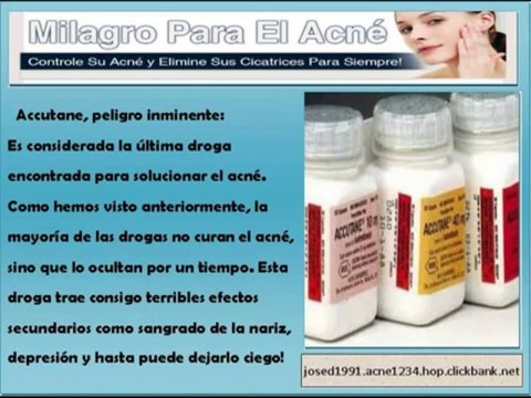 Milagro para el acne. Controle su Acne y elimine sus cicatrices para siempre!