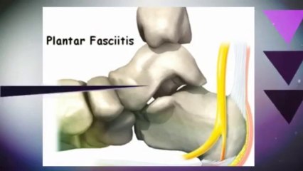 Plantar Fasciitis Total Cure Review - Breakthrough Podiatrist Designed System