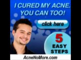 Acne No More Ebook - Acne No More System Download Video