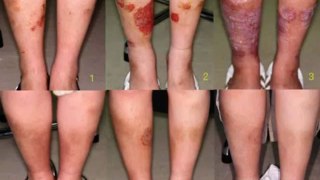 psoriasis free for life download