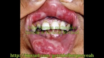 How to permanently get rid of herpes