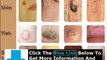 Does Moles Warts & Skin Tags Removal Really Work + Moles Warts And Skin Tags