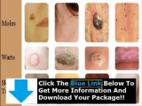 Does Moles Warts & Skin Tags Removal Really Work   Moles Warts And Skin Tags