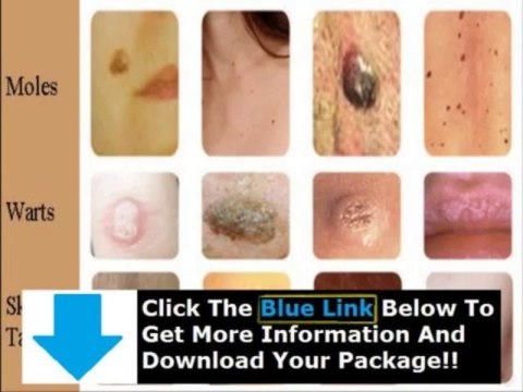 Does Moles Warts & Skin Tags Removal Really Work + Moles Warts And Skin Tags