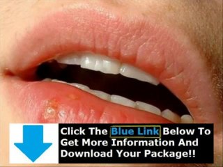 How To Get Rid Of Herpes On Your Lip + Can I Get Rid Of Herpes