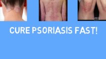 Cure Psoriasis | Psoriasis Free For Life | Cure Psoriasis Fast