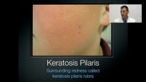 Banish my bumps find out how I use Banish my bumps to eliminate Keratosis Pilaris