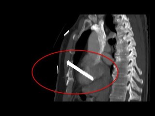 Carpenter Eugene Rakow shoots himself in heart with nail gun