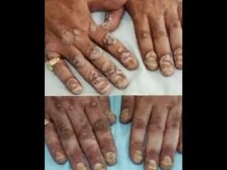 Candida Crusher - Permanent Yeast Infection Solution By Dr Eric Bakker