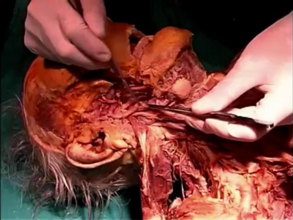 Human Anatomy Dissection 14 (part 1 of 2) Deep Neck