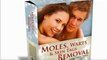 Moles Warts And Skin Tags Removal Review | Remove Moles, Warts & Skin Tags