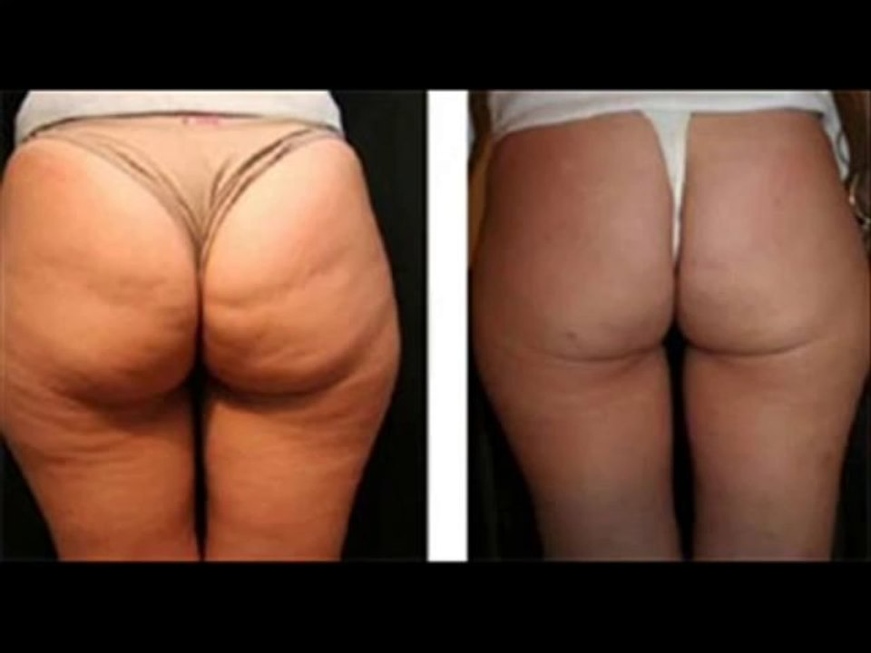 Como eliminar la celulitis rapido -Eliminar celulitis - [celulitis nunca mas]