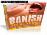 Banish Tonsil Stones PDF - Banish Tonsil Stones By Diane Puttman
