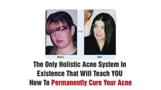 Acne No More Part 2 - The secrets to Curing Your Acne Holistically