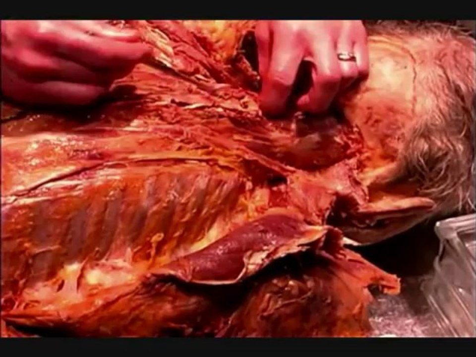 Human Anatomy Dissection 02 Back Muscles And Spinal Cord 