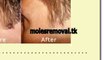 Moles, Warts & Skin Tags Removal Review | Is Moles, Warts & Skin Tags Removal Any Good?