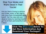 Moles Warts And Skin Tags Removal pdf   Moles Warts & Skin Tags Removal Ebook