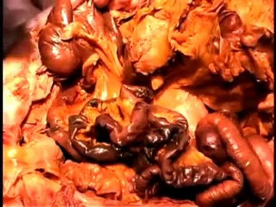 Peritoneal & Inguinal-Human Anatomy Dissection