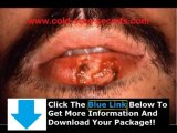How To Get Rid Of Herpes For Good   Get Rid Of Herpes Blisters Fast