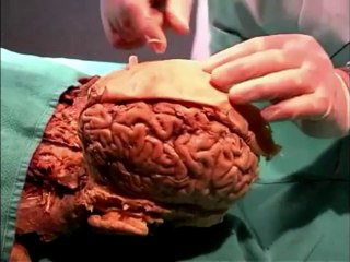 Human Anatomy Dissection 15 (part 2 of 2) Brain