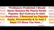 Pearly Penile Papules Removal Cost - Pearly Penile Papules Removal Home Remedy